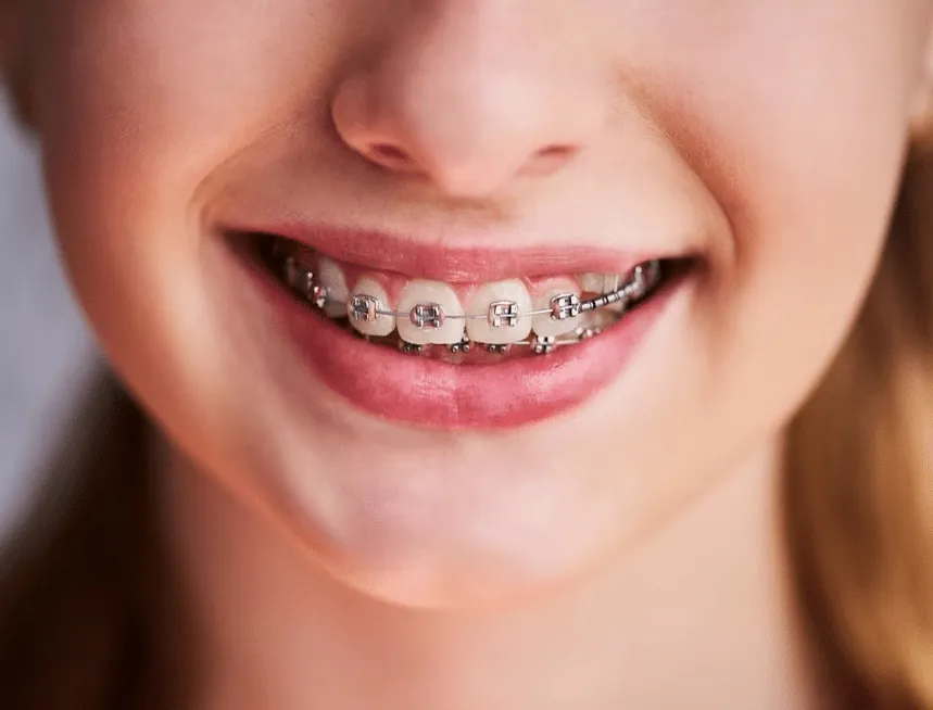 Todo lo que necesitas saber sobre los brackets para niños